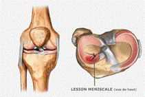 esion meniscale