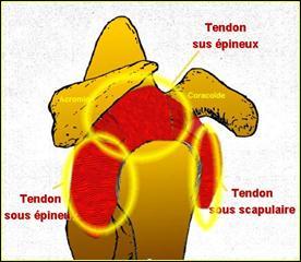 CONFLIT SOUS ACROMIAL 3