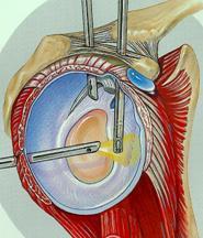 CONFLIT SOUS ACROMIAL 6