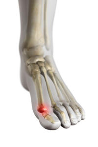 HALLUX RIGIDUS 1