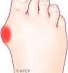 HALLUX VALGUS 1