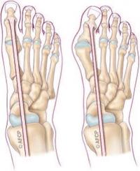 HALLUX VALGUS 2