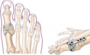 HALLUX VALGUS 3