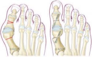 HALLUX VALGUS 4