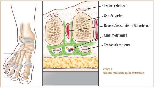 évrome de morton ou névralgie inter-métatarsienne