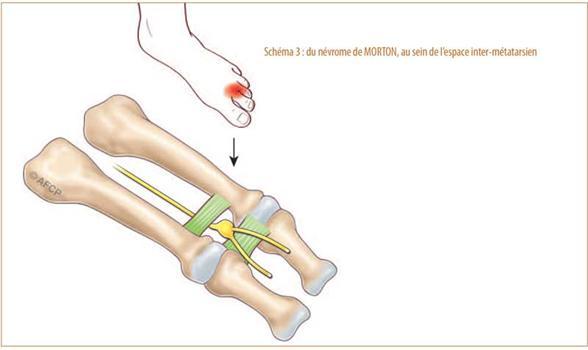 évrome de morton ou névralgie inter-métatarsienne