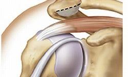 impingement-syndrome-3