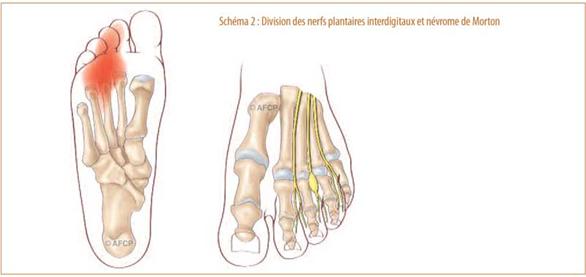 évrome de morton ou névralgie inter-métatarsienne