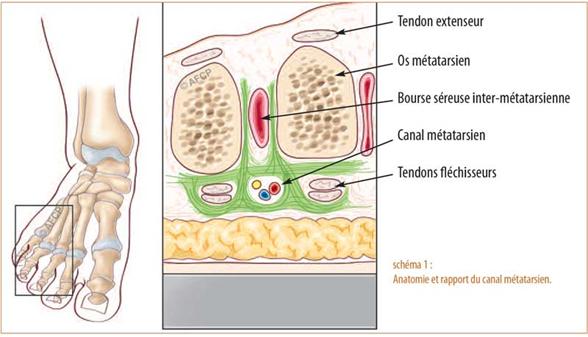 évrome de morton ou névralgie inter-métatarsienne